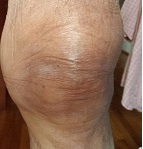 bad knee pre surg12-18cut